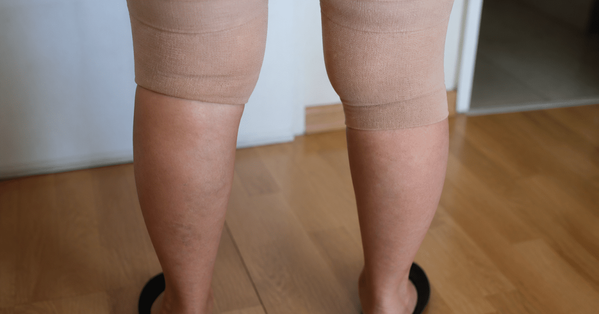 Genoux enfles avec bande de compression medicale appliquee