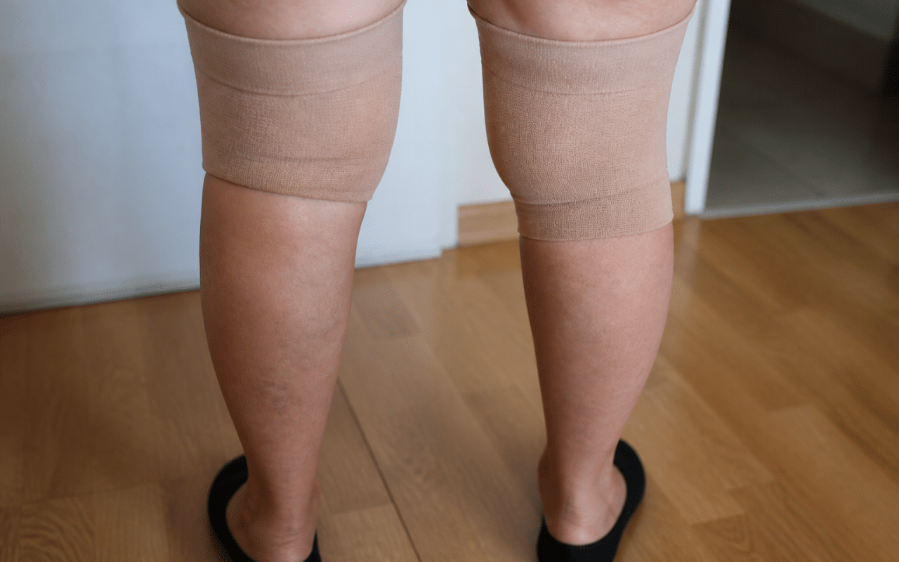 Genoux enfles avec bande de compression medicale appliquee